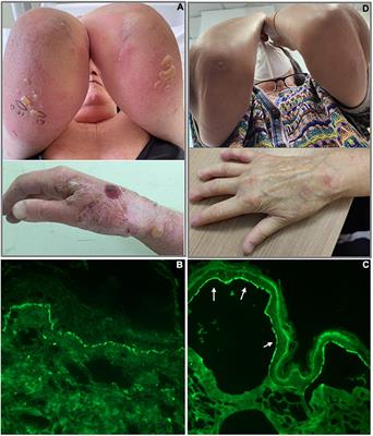 Case report: Bullous pemphigoid arising in a patient with scleroderma and multiple sclerosis